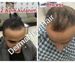 Dermanew hair 