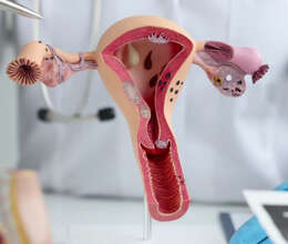 Endometrioz problemi və təbii müalicəsi