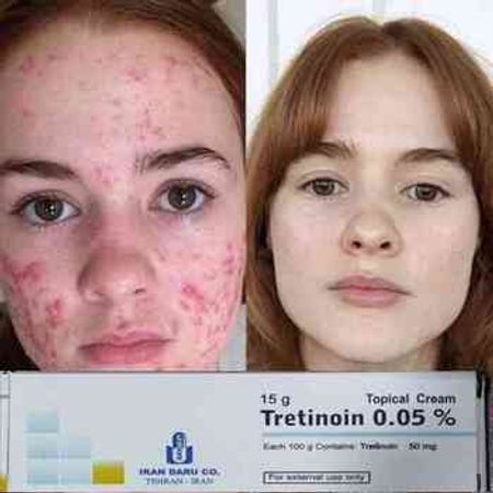 Tretinoin Kremi – Azərbaycan – ucuztap.az