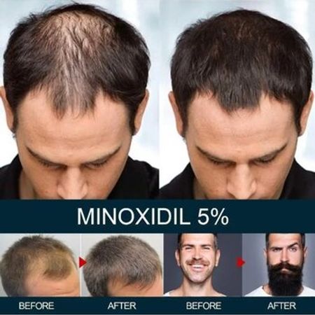 Saç Serumu Minoxidil Kirkland – Azərbaycan – ucuztap.az