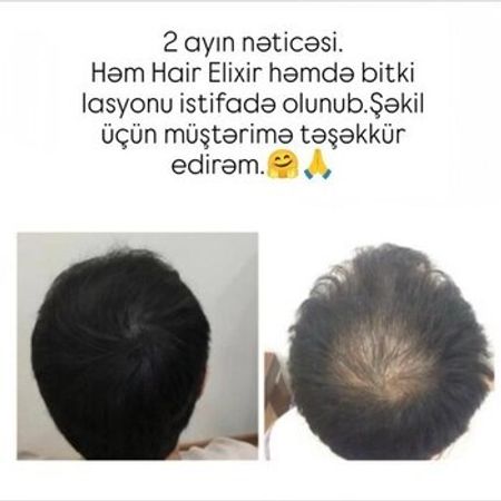 Saç Tökülməsinə Qarşı Serum – Sağlamlıq və gözəllik – ucuztap.az